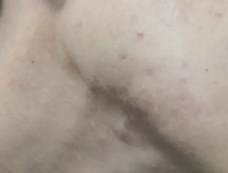 痤疮疤痕